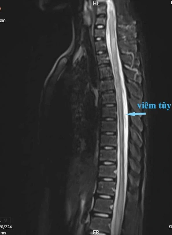 Hành trình hồi phục kỳ diệu của cậu bé 14 tuổi mắc bệnh viêm tủy ngang
