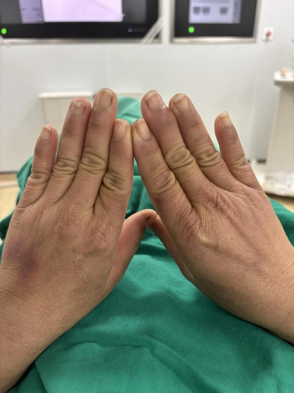 Mắc phải hội chứng lạ, người phụ nữ đau đớn mỗi khi chạm tay vào nước