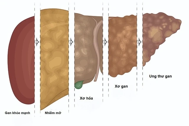 Uống cà phê có giúp bảo vệ gan khỏi nguy cơ ung thư không?