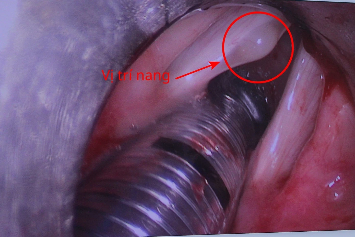 Khàn tiếng, hụt hơi... coi chừng mắc bệnh lý nguy hiểm