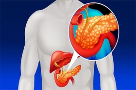 5 loại thực phẩm “giết chết” tuyến tụy