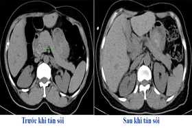 Tán sỏi đường mật qua da - Phương pháp điều trị sỏi mật an toàn, hiệu quả
