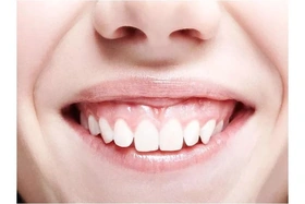 Làm sao để khắc phục tình trạng cười hở lợi