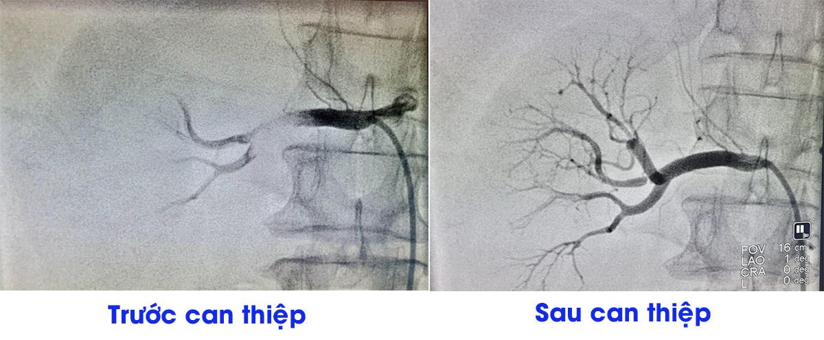 Nhồi máu thận được điều trị khỏi nhờ kỹ thuật can thiệp thường quy