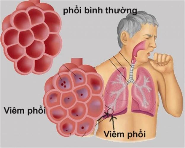 Mẹo kiểm soát bệnh viêm phổi mùa Đông