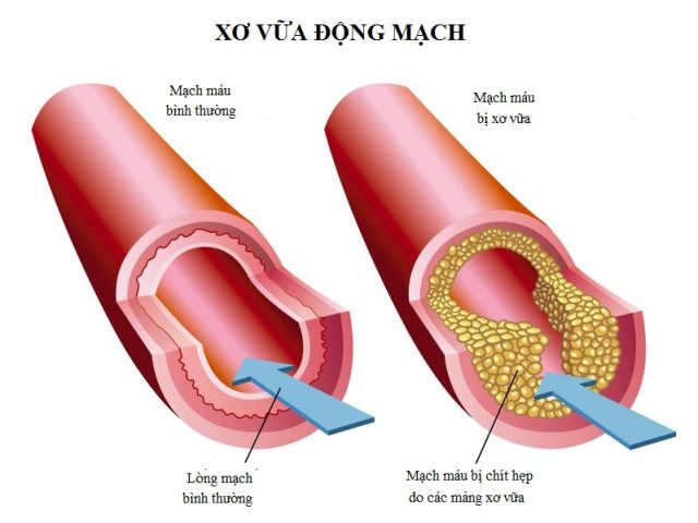 8 cách giúp phòng xơ vữa động mạch, ngăn ngừa đột quỵ