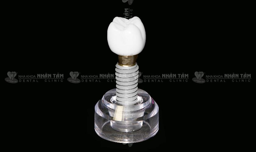 Trồng răng Implant-Những điều cần biết trước khi làm