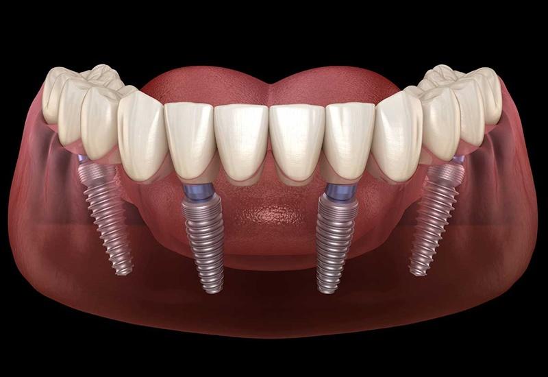 Trồng răng Implant-Những điều cần biết trước khi làm