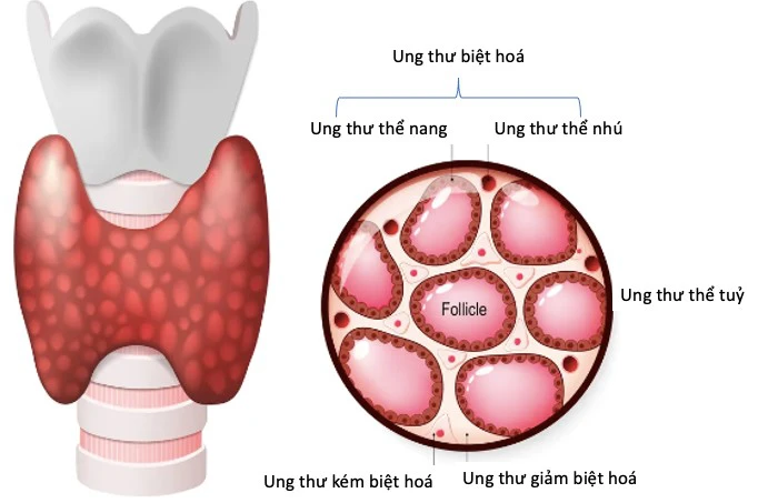 Các dấu hiệu sớm của ung thư tuyến giáp cần biết