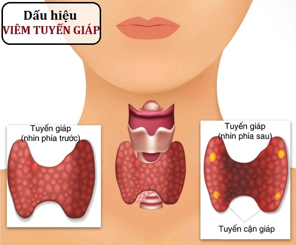 Nguyên nhân gây viêm tuyến giáp Hashimoto