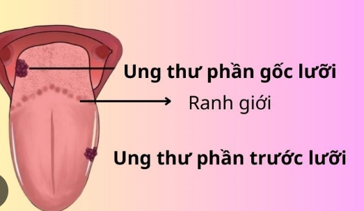 Người bệnh ung thư lưỡi nên tập luyện như thế nào?