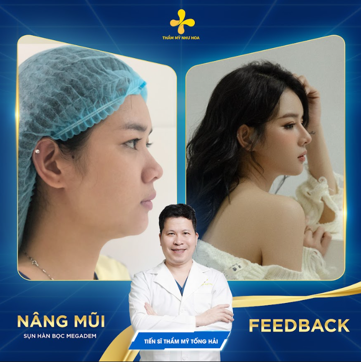 Nâng mũi đẹp tự nhiên tại thẩm mỹ Như Hoa - Từng bước tiến gần đến sự hoàn mỹ