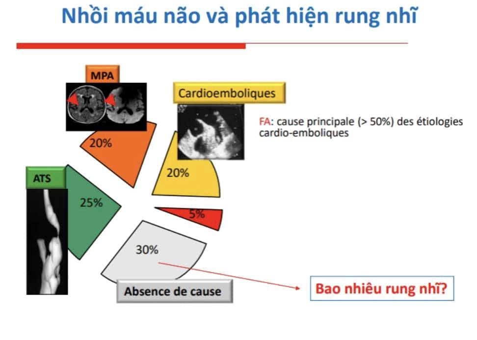 Dự phòng đột quỵ do rung nhĩ