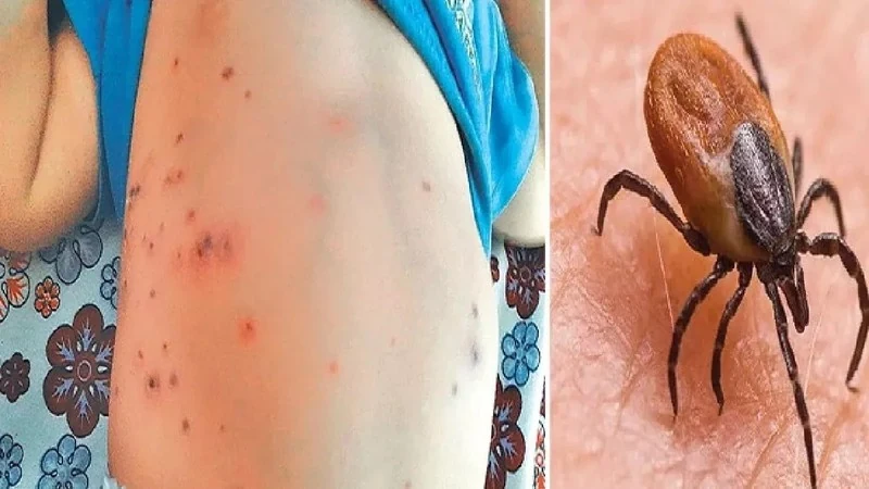 Các câu hỏi thường gặp liên quan đến sốt ve mò