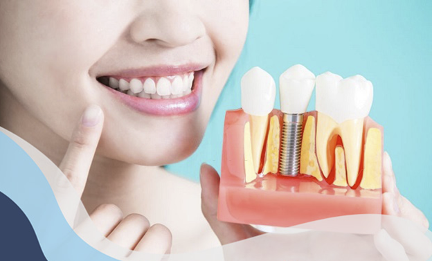 Khi nào cần trồng răng implant? Trồng răng implant có đau không?