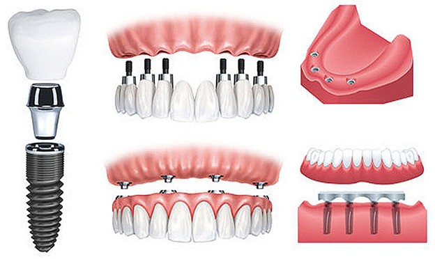 Khi nào cần trồng răng implant? Trồng răng implant có đau không?