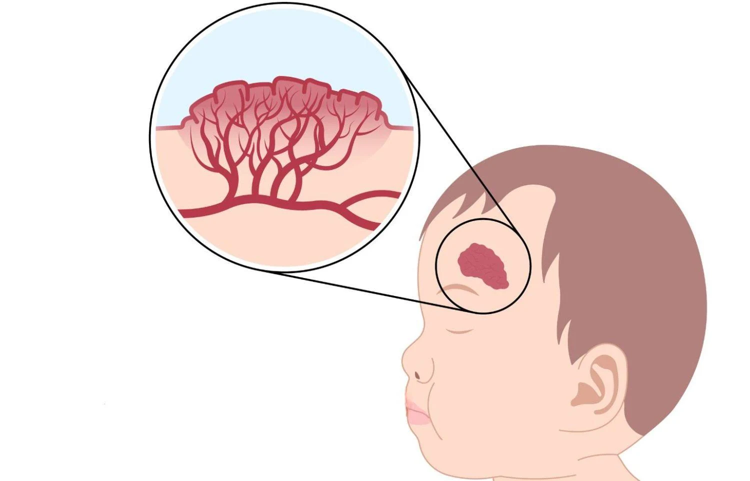 Người bị u máu cần chú ý gì về dinh dưỡng?