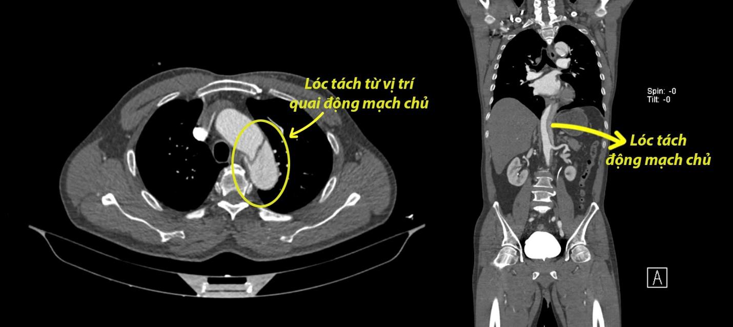 Kỹ thuật Hybrid cứu sống người bệnh nặng do lóc tách động mạch chủ ngực