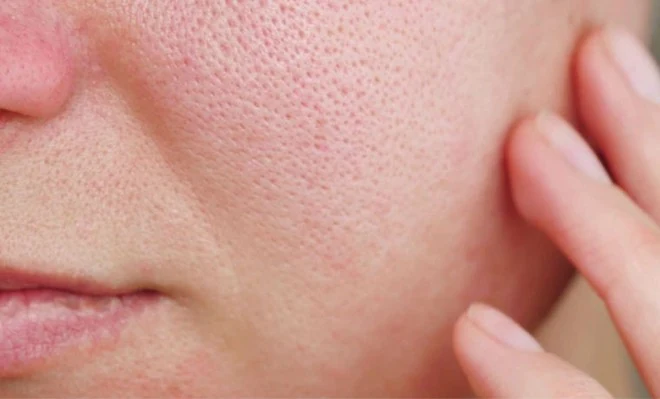 Đâu là cách giúp se khít lỗ chân lông da mặt hiệu quả nhất?