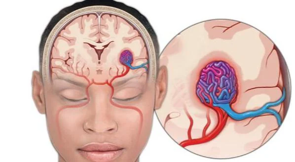Câu hỏi thường gặp liên quan đến dị dạng mạch não
