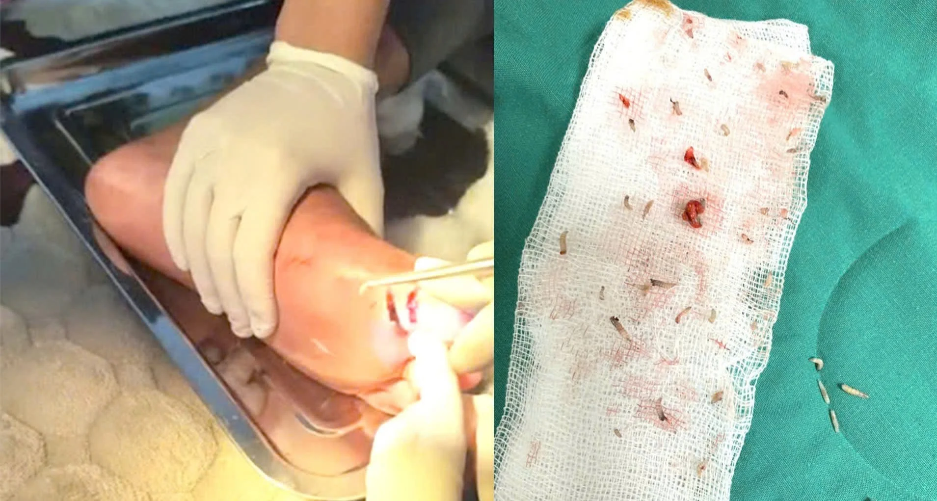 “Bắt 30 con giòi sống trong vết thương của người bệnh