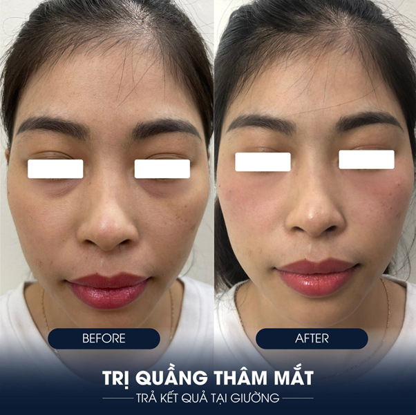 Top 5 địa chỉ trị thâm uy tín, chất lượng tốt ở TPHCM