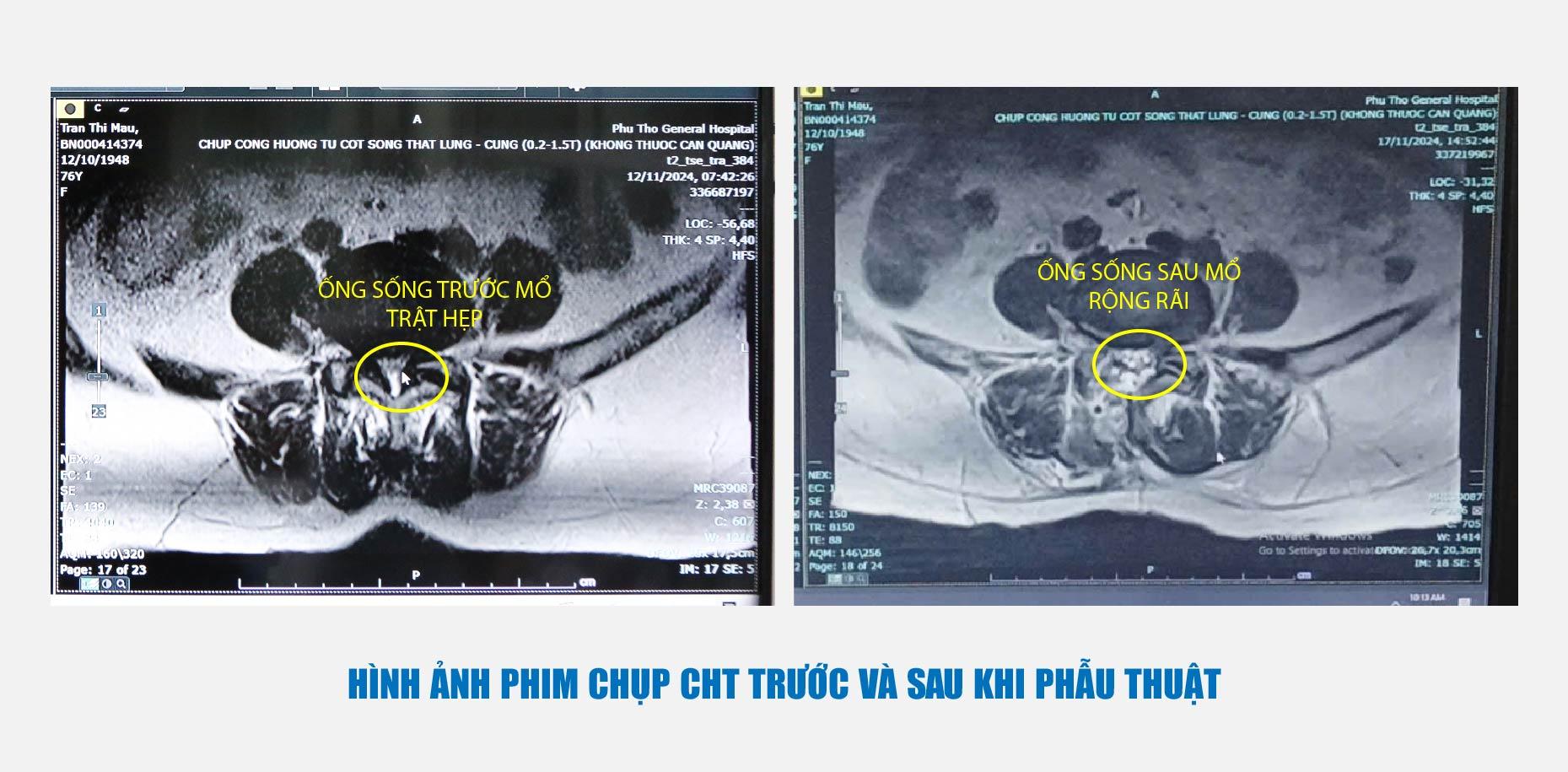 Phẫu thuật nội soi hai cổng: Lựa chọn an toàn và hiệu quả cho người mắc bệnh lý hẹp ống sống thắt lưng do thoái hóa