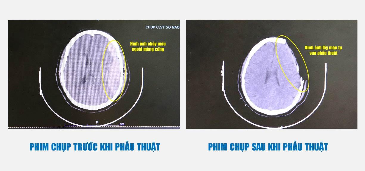 Chảy máu não sau cú ngã thang 3 mét, người đàn ông thoát hiểm nhờ phương pháp hạ thân nhiệt chỉ huy