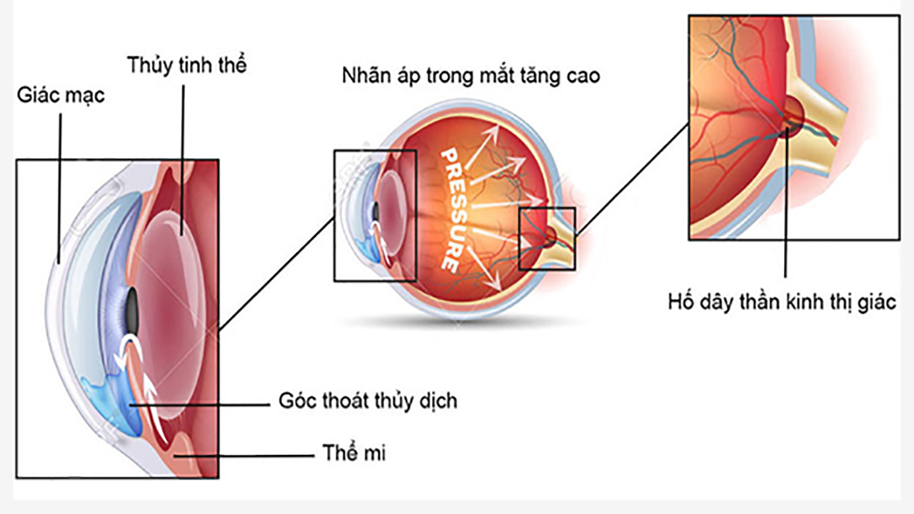 6 bước ngăn ngừa tăng nhãn áp gây hại thêm cho thị lực