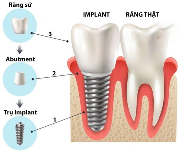 Quá trình trồng răng implant có đau không?