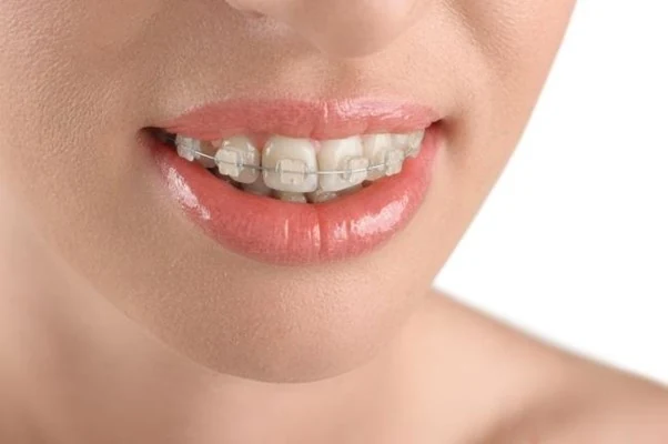 Các loại niềng răng hiện nay để cải thiện răng hô nhẹ