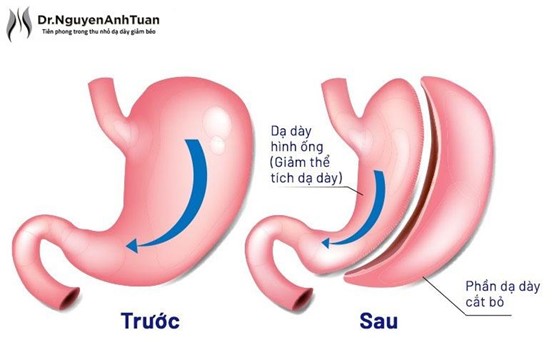 Hành trình cải thiện cân nặng và sức khỏe sau 8 tháng phẫu thuật thu nhỏ dạ dày