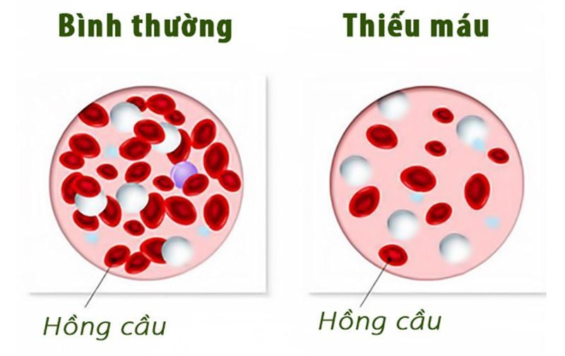 Tay chân lạnh cảnh báo điều gì?