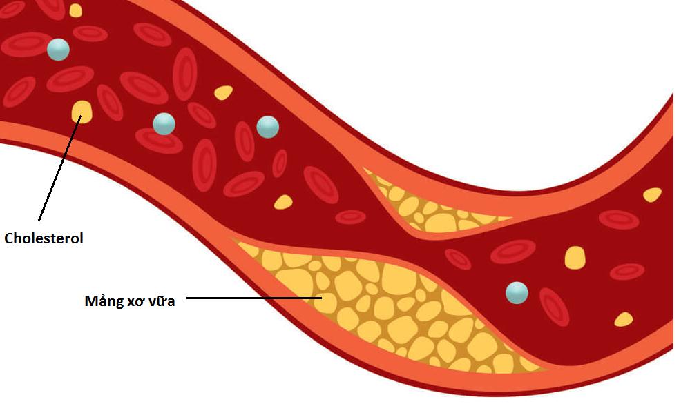 5 chất dinh dưỡng giúp loại bỏ cholesterol xấu