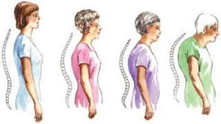 Chế độ ăn có ích với người gù cột sống