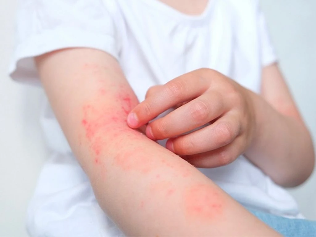 Bài thuốc điều trị viêm da cơ địa