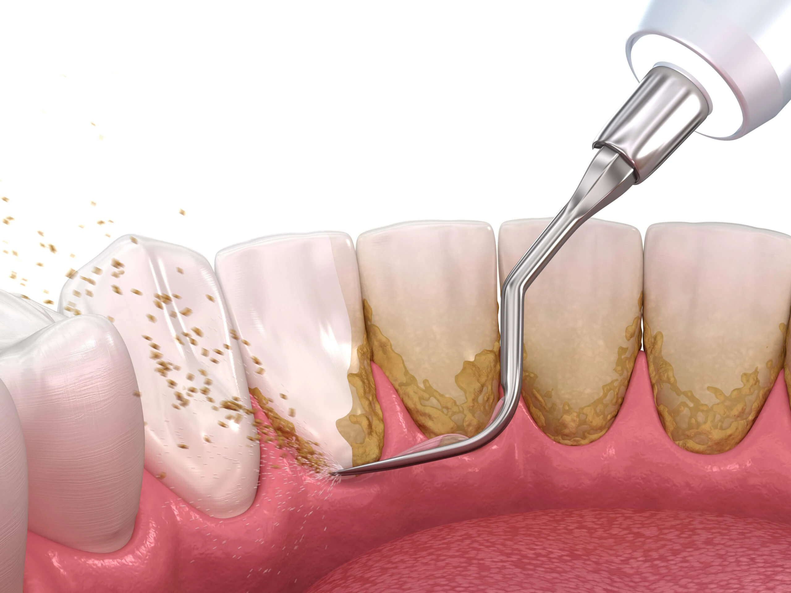 4 nhóm thực phẩm dễ gây hình thành mảng bám và cao răng