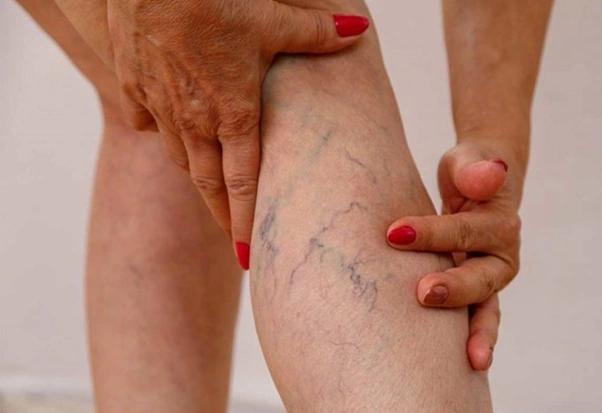 Giải mã cơn ác mộng của phái đẹp mang tên suy giãn tĩnh mạch chân