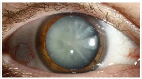 Bệnh tiểu đường ảnh hưởng đến mắt như thế nào, có phòng ngừa được không?