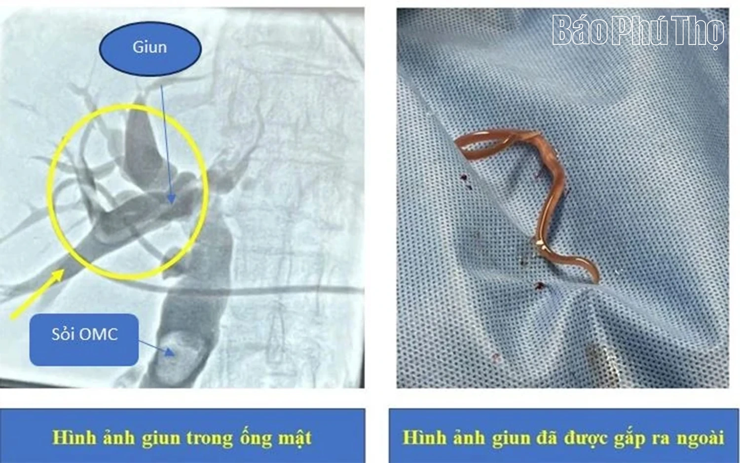 Kịp thời cứu chữa sỏi mật gây tắc ống mật và giun trong đường mật cho người bệnh