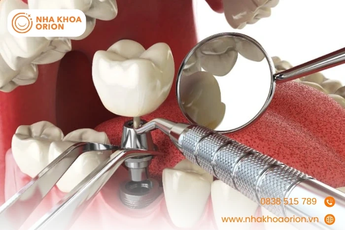 Nha khoa Orion - Địa chỉ cấy ghép Implant uy tín, chất lượng cao