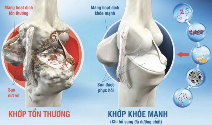 5 khớp trên cơ thể dễ bị thoái hóa