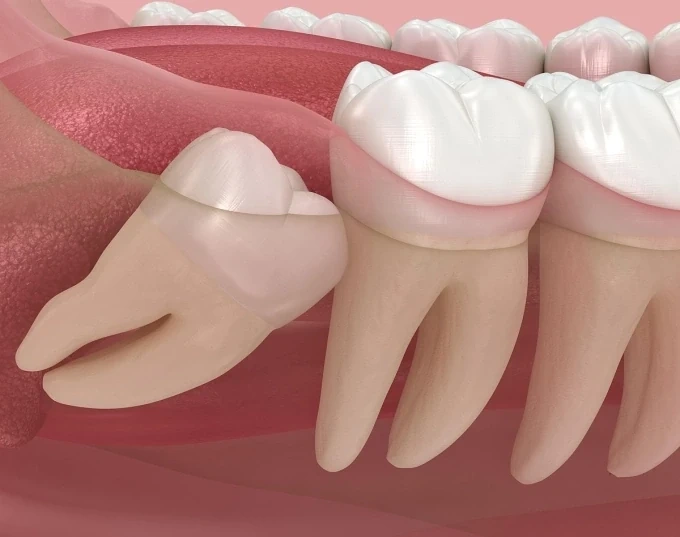 Nhổ răng khôn có cần trồng lại không? Giải đáp từ góc nhìn nha khoa