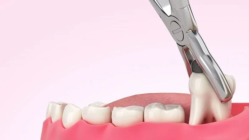 Nhổ răng khôn có cần trồng lại không? Giải đáp từ góc nhìn nha khoa