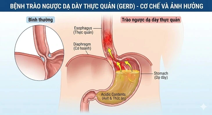 Vì sao người bệnh trào ngược dạ dày không nên dùng bạc hà?