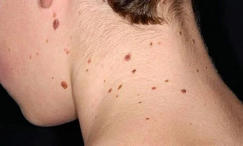 Chủ động nhận diện, phòng ngừa ung thư da