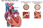 4 bài tập tốt cho người hẹp van động mạch chủ