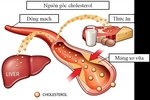 5 loại thực phẩm giúp kiểm soát mức cholesterol