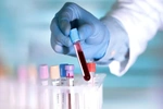 Xét nghiệm “nano vàng” giá rẻ, phát hiện bệnh chết người qua một giọt máu