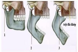 Nam bệnh nhân trật khớp hàm vì ngáp lớn phải nhập viện